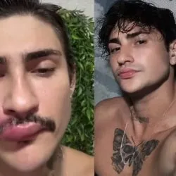 influenciador ken humano é hospitalizado após espremer espinha