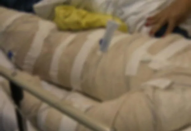 Menino de 11 anos fica em estado grave após queimaduras em brincadeira com álcool em Campo Grande