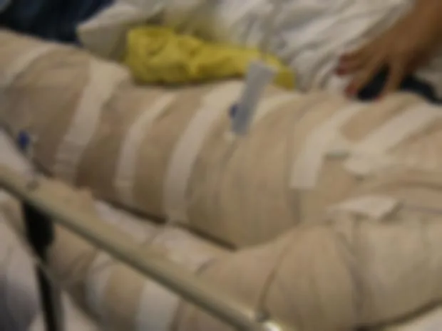 Menino de 11 anos fica em estado grave após queimaduras em brincadeira com álcool em Campo Grande