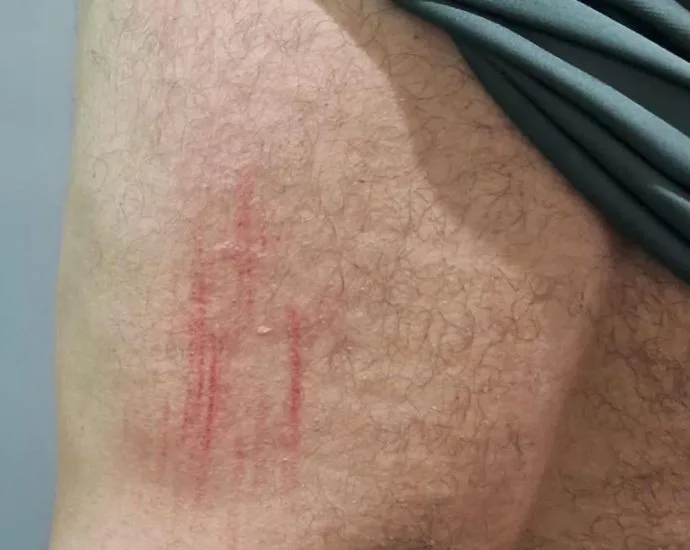 Agente comunitário é atacado por Pitbull em Ribas do Rio Pardo
