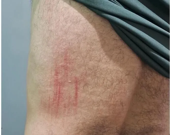 Agente de saúde atacado por pitbull durante visita domiciliar em Ribas do Rio Pardo
