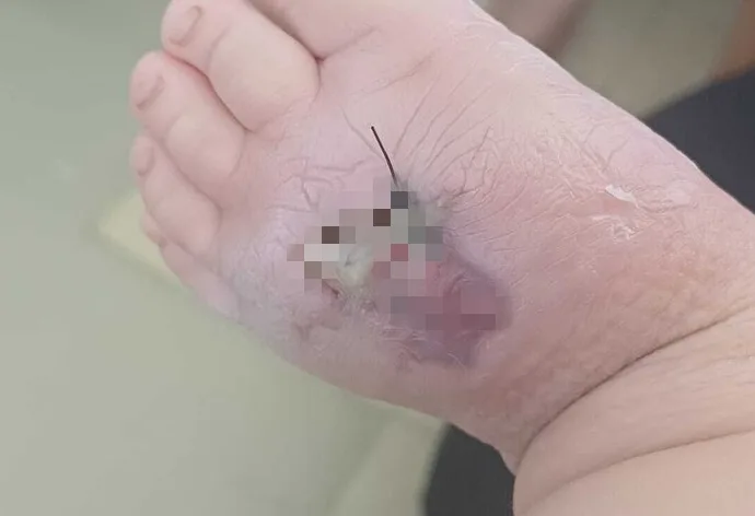 Bebê de 1 ano internado em Campo Grande após picada de aranha