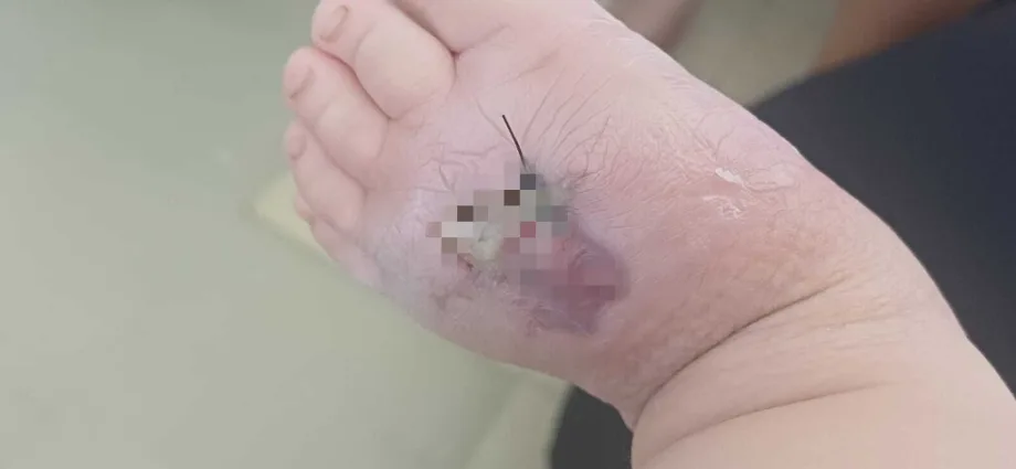 Bebê de 1 ano internado em Campo Grande após picada de aranha