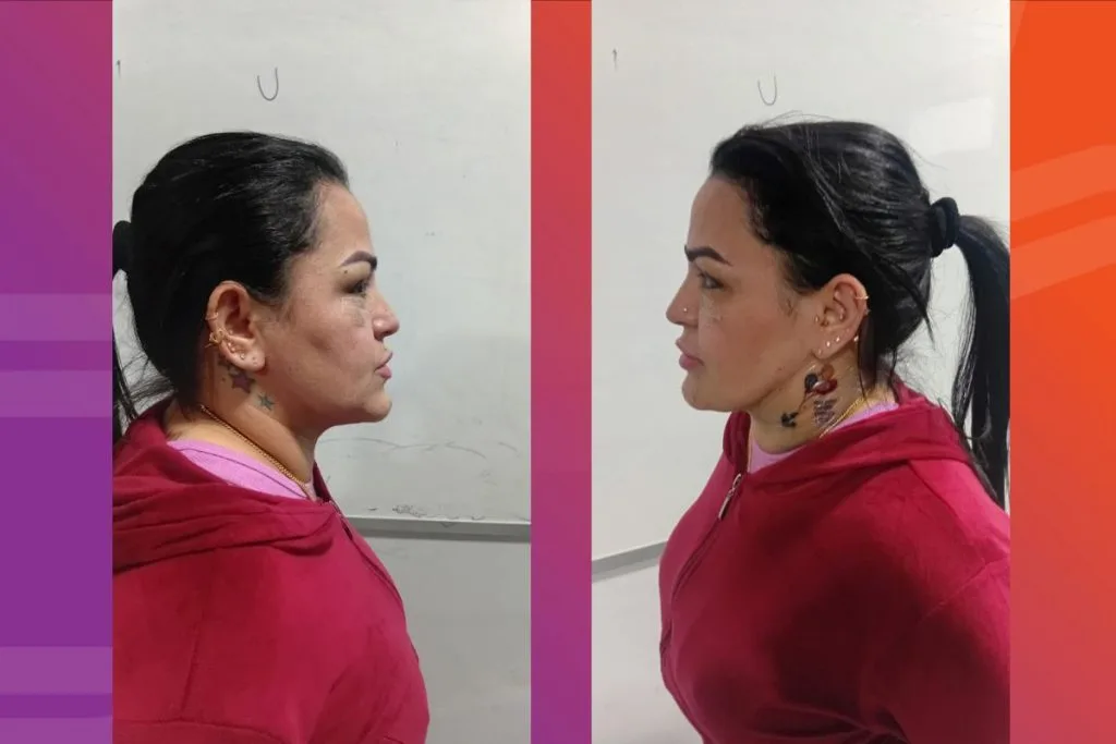 Angeliquinha foi presa em um polo de cirurgias plásticas de baixo custo na Bolívia. - Foto: Reprodução