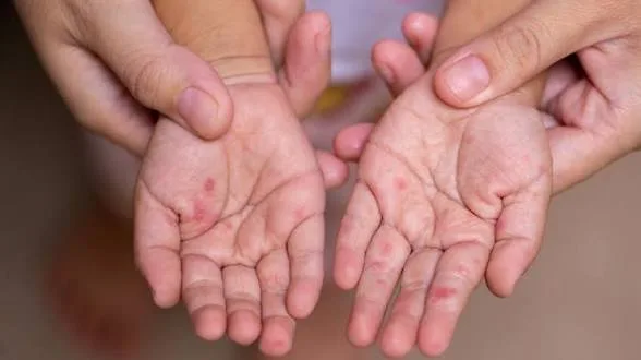 Surto de mão, pé e boca leva à interdição de creche em Três Lagoas